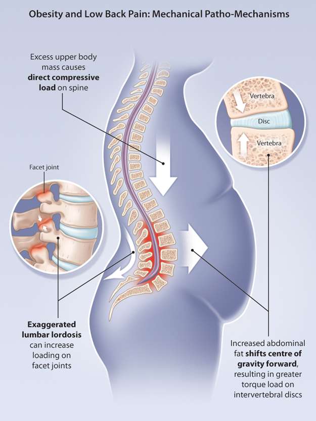 Is Back Pain A Common Consequence Of Weight Loss